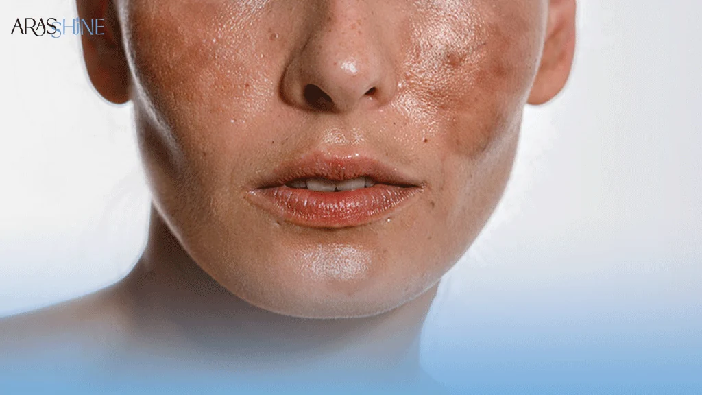 تجمع سلول های مرده