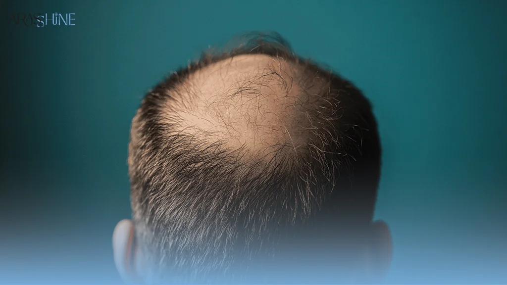 ریزش غیرطبیعی مو